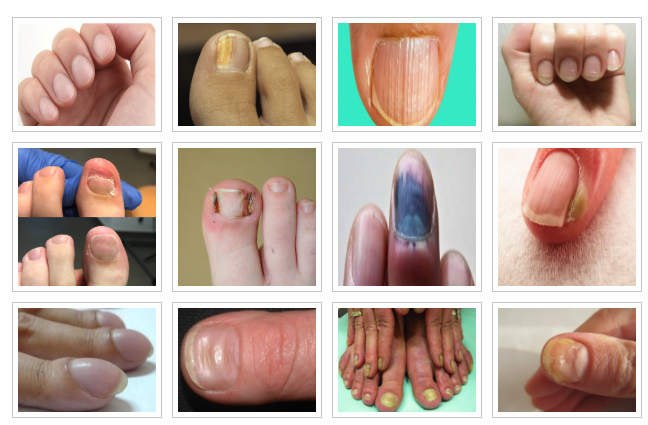 Líneas en Uñas
