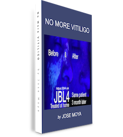 No More Vitiligo