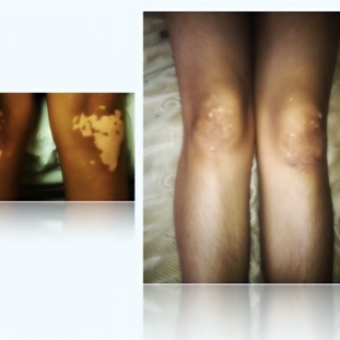 Vitiligo in Knees