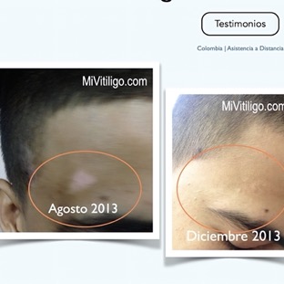 Vitiligo on the forehead.jpg