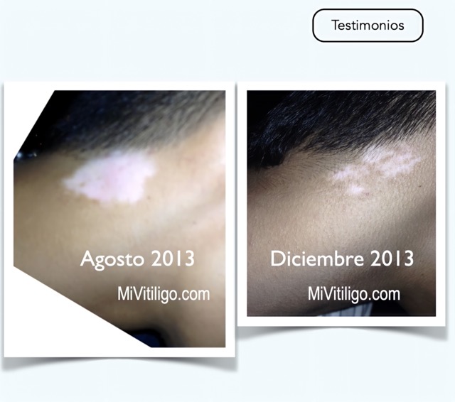 Vitiligo on the neck